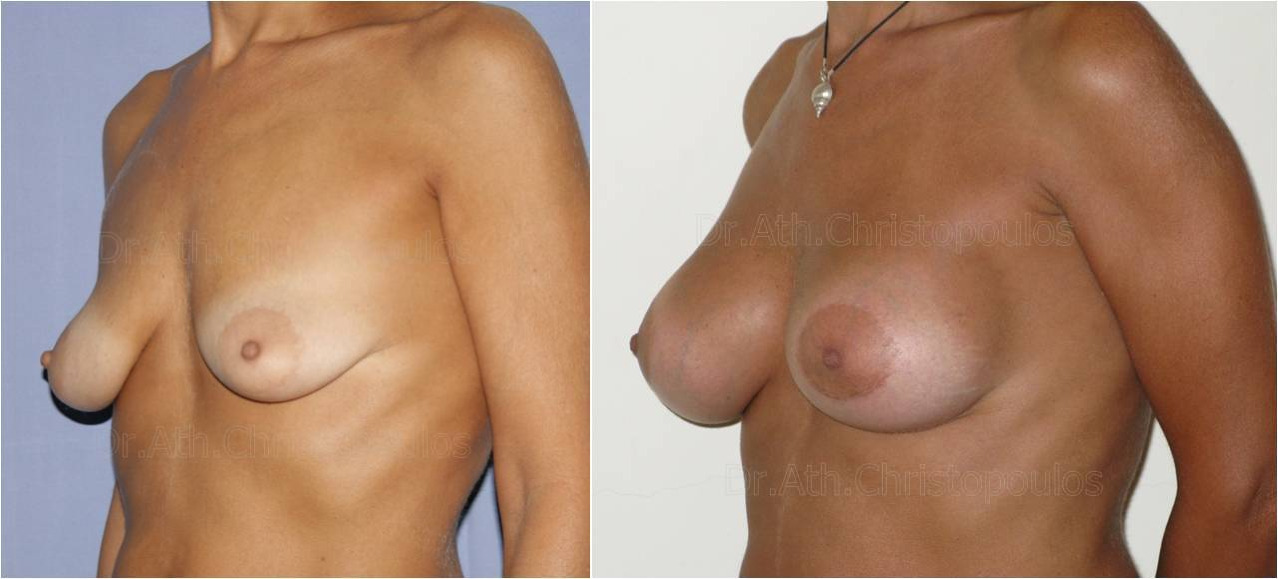 AFKSITIKI STITHOUS 13