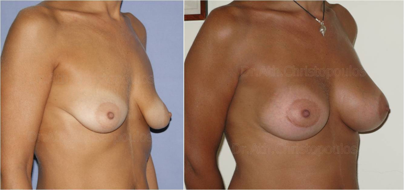 AFKSITIKI STITHOUS 14