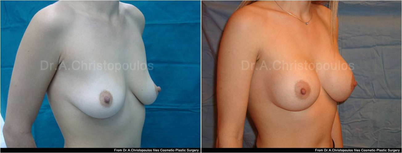 AFKSITIKI STITHOUS 18