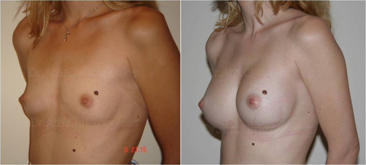 AFKSITIKI STITHOUS 9