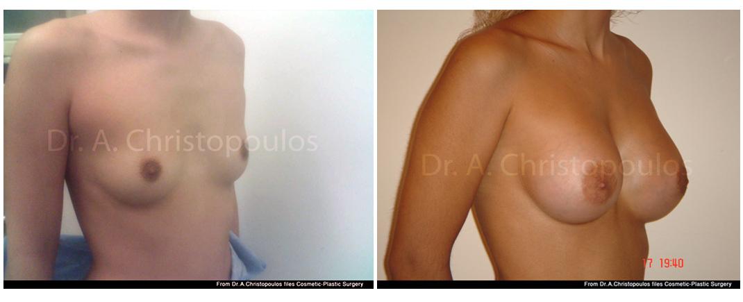 afxitikh stithous prin meta2