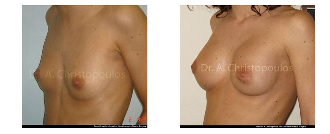 afxitikh stithous prin meta3