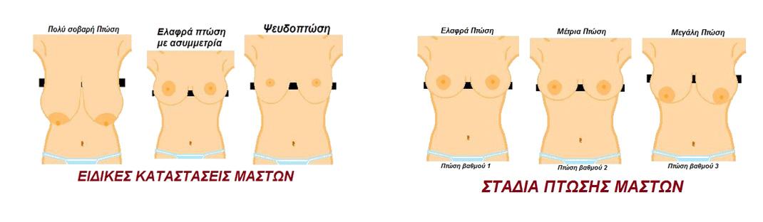 ανορθωση στηθους