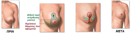 ανορθωση στηθους