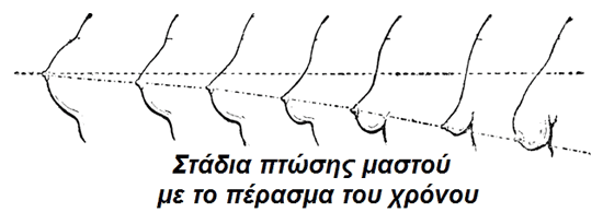 ανορθωση πτωτικου στηθους