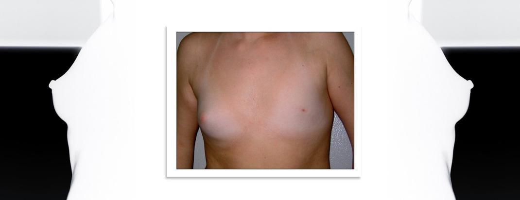 απλασια θηλης