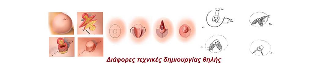 απλασια θηλης τεχνικες δημιουργιας 