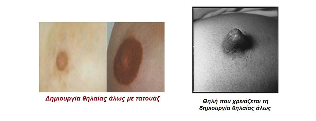 απλασια θηλης τεχνικες