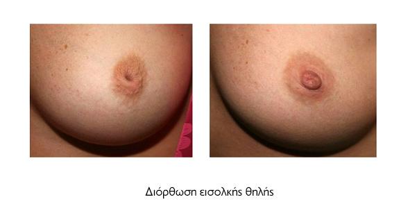 εισολκη θηλης