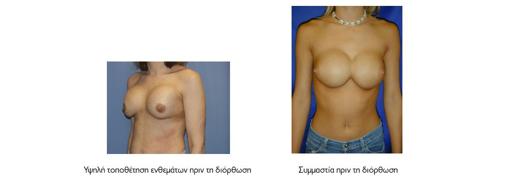 λαθος τοποθετηση ενθεματων σιλικονης