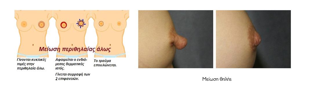 μειωση θηλης