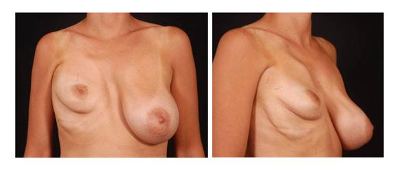 συνδρομο poland