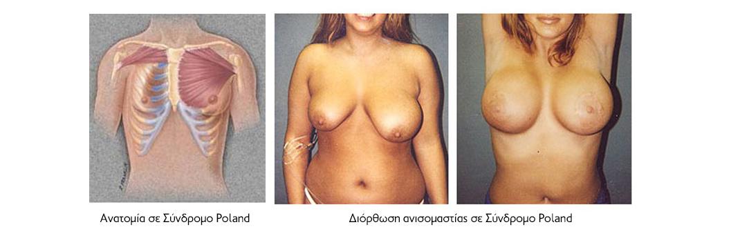 συνδρομο poland ανατομια