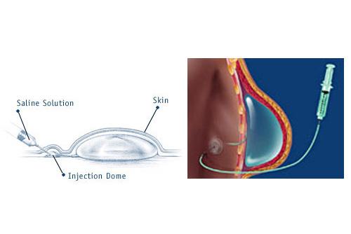 προσθήκη υγρού αυξητικη στηθους
